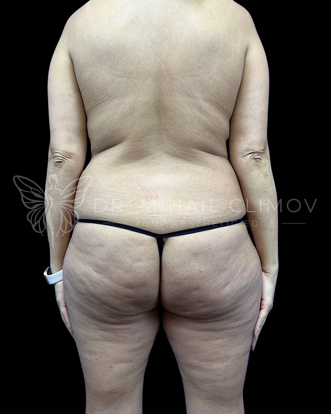 Before Vaser lipo 360 surgery – back view – Dr. Mihail Climov, Aesthetic Plastic Surgeon, Houston, TX