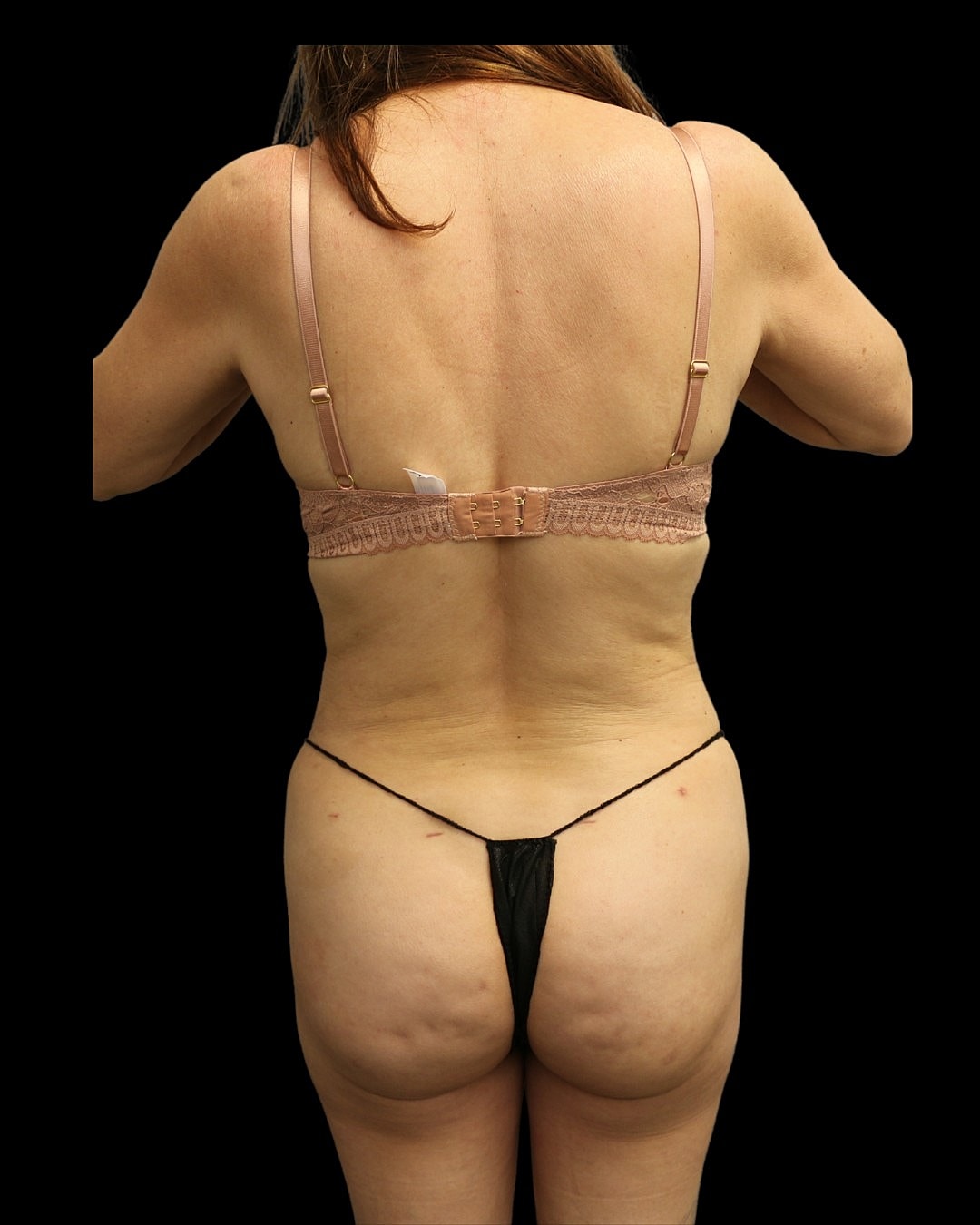 Liposuction Before & After