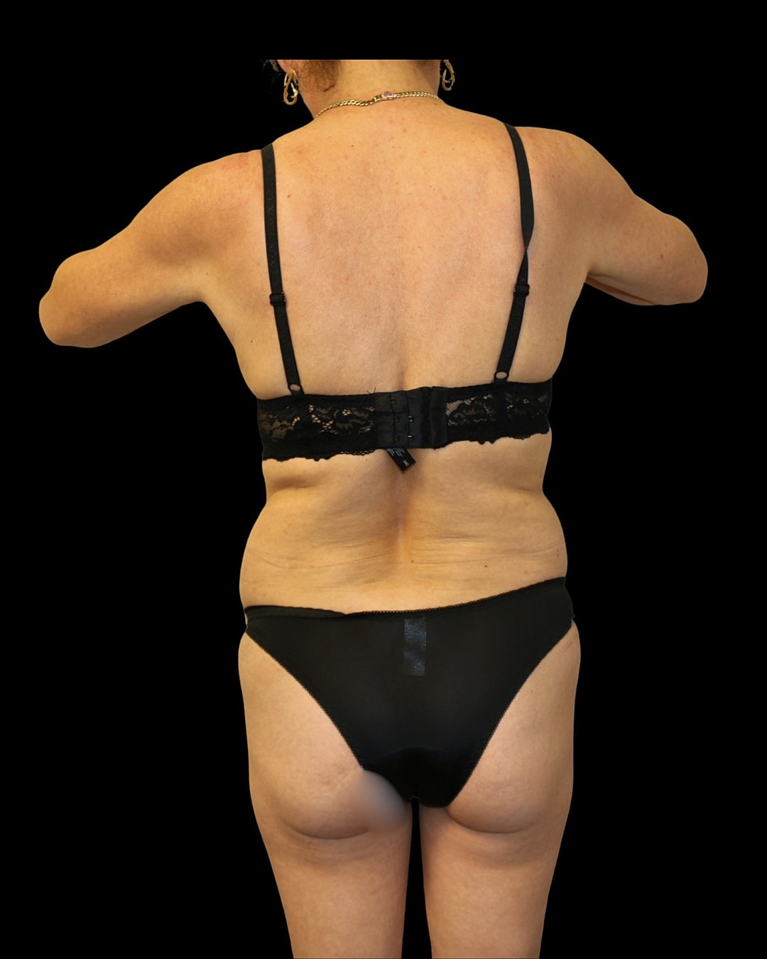 Liposuction Before & After