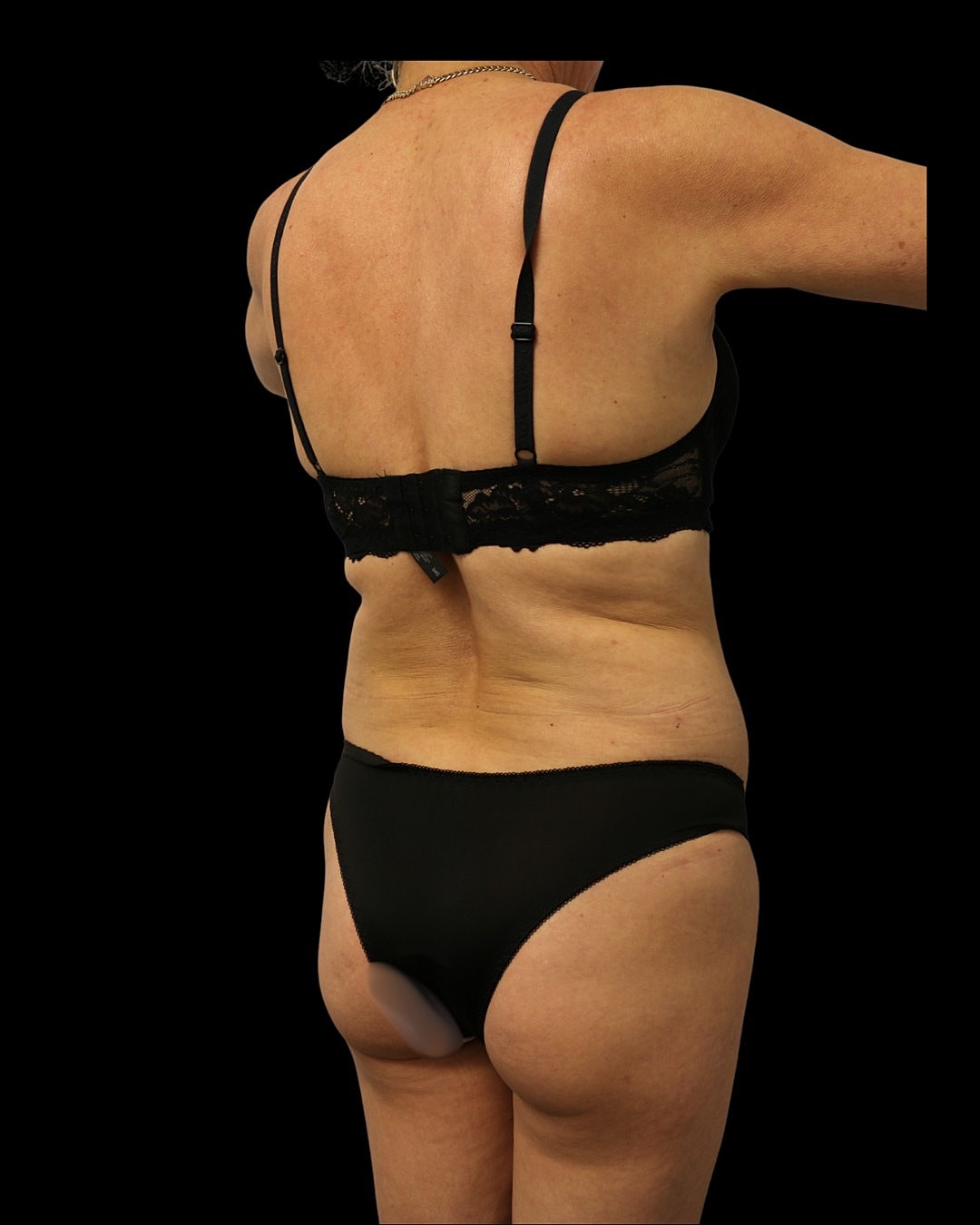 Liposuction Before & After