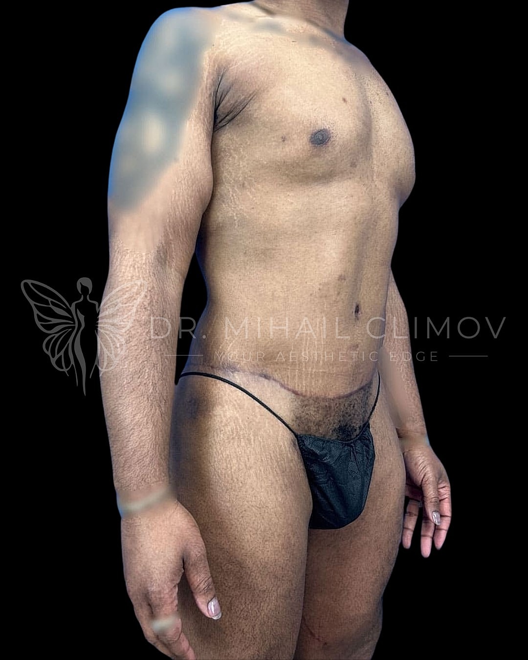 Male torso in anatomical pose against black background.