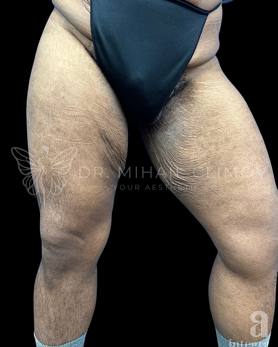 Close-up of legs with skin texture details.