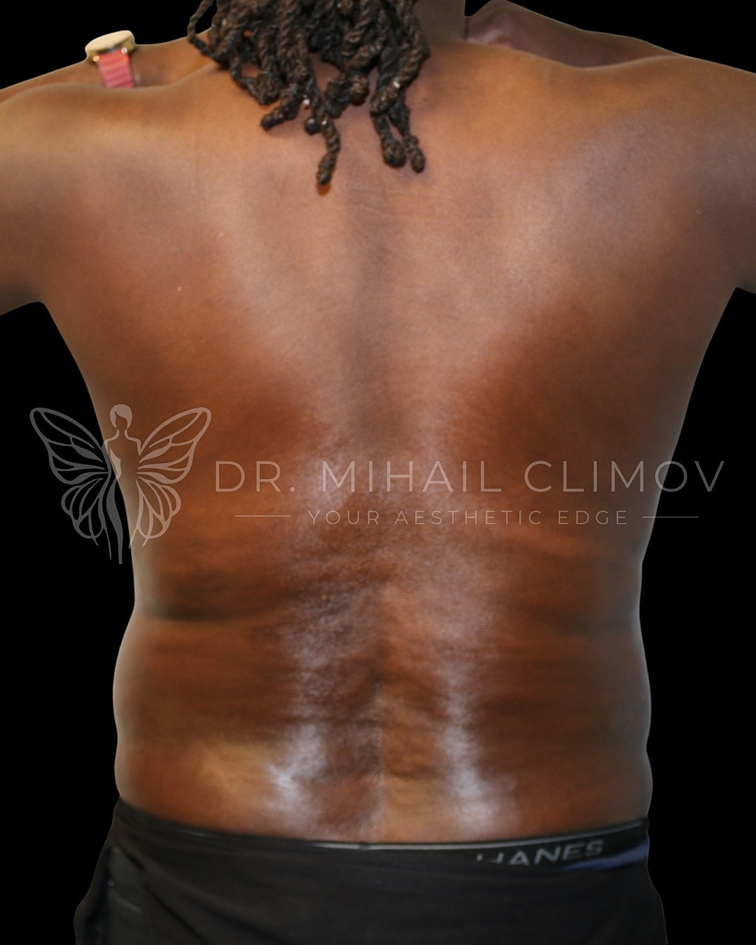 Case_001_after_front__7_.png After daddy do-over results – back view – Dr. Mihail Climov, Aesthetic Plastic Surgeon, Houston, TX
