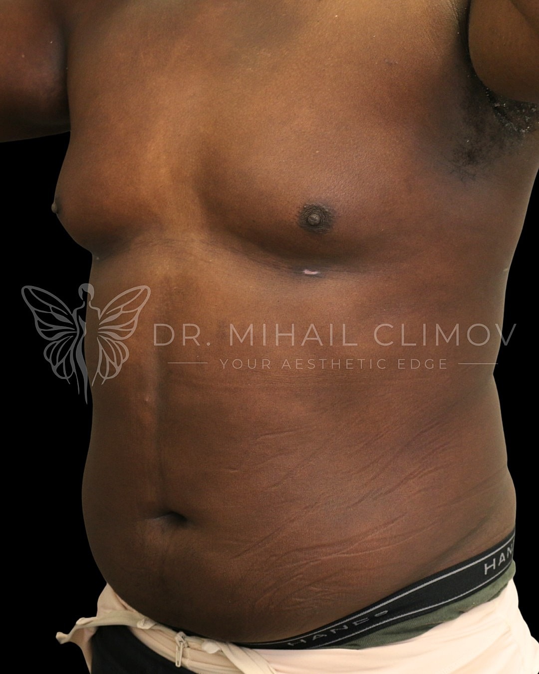 Case_001_after_front__9_.png After daddy do-over results – 3/4 angle view – Dr. Mihail Climov, Aesthetic Plastic Surgeon, Houston, TX