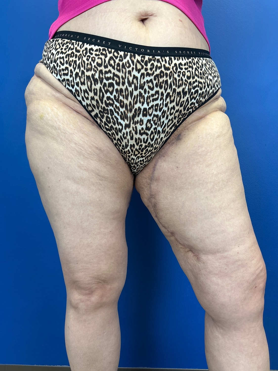 Thigh Lift Before & After
