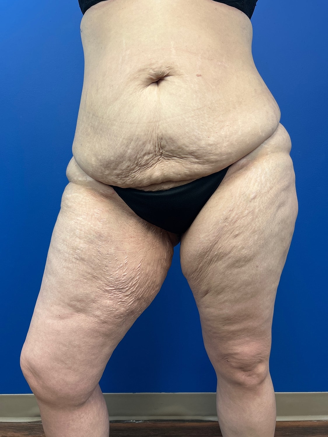 Thigh Lift Before & After