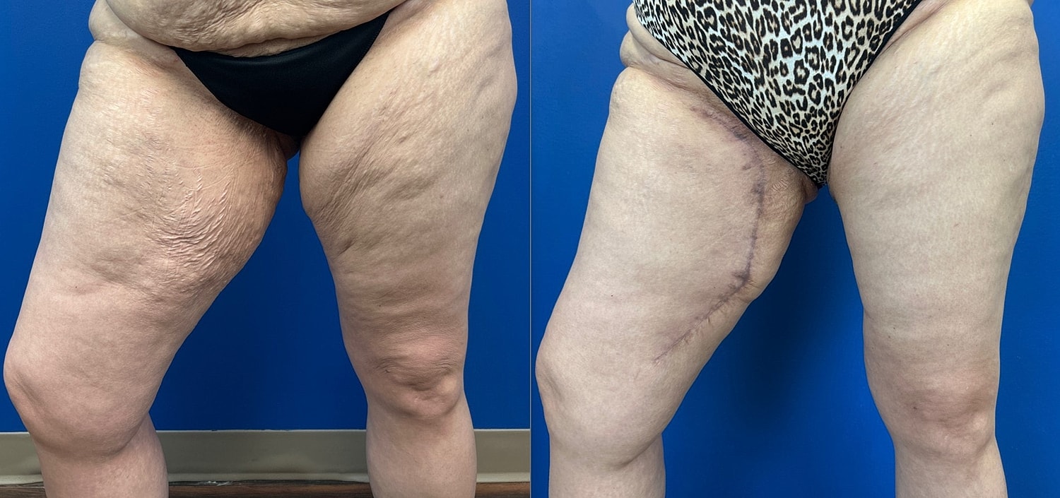 Thigh Lift Before & After