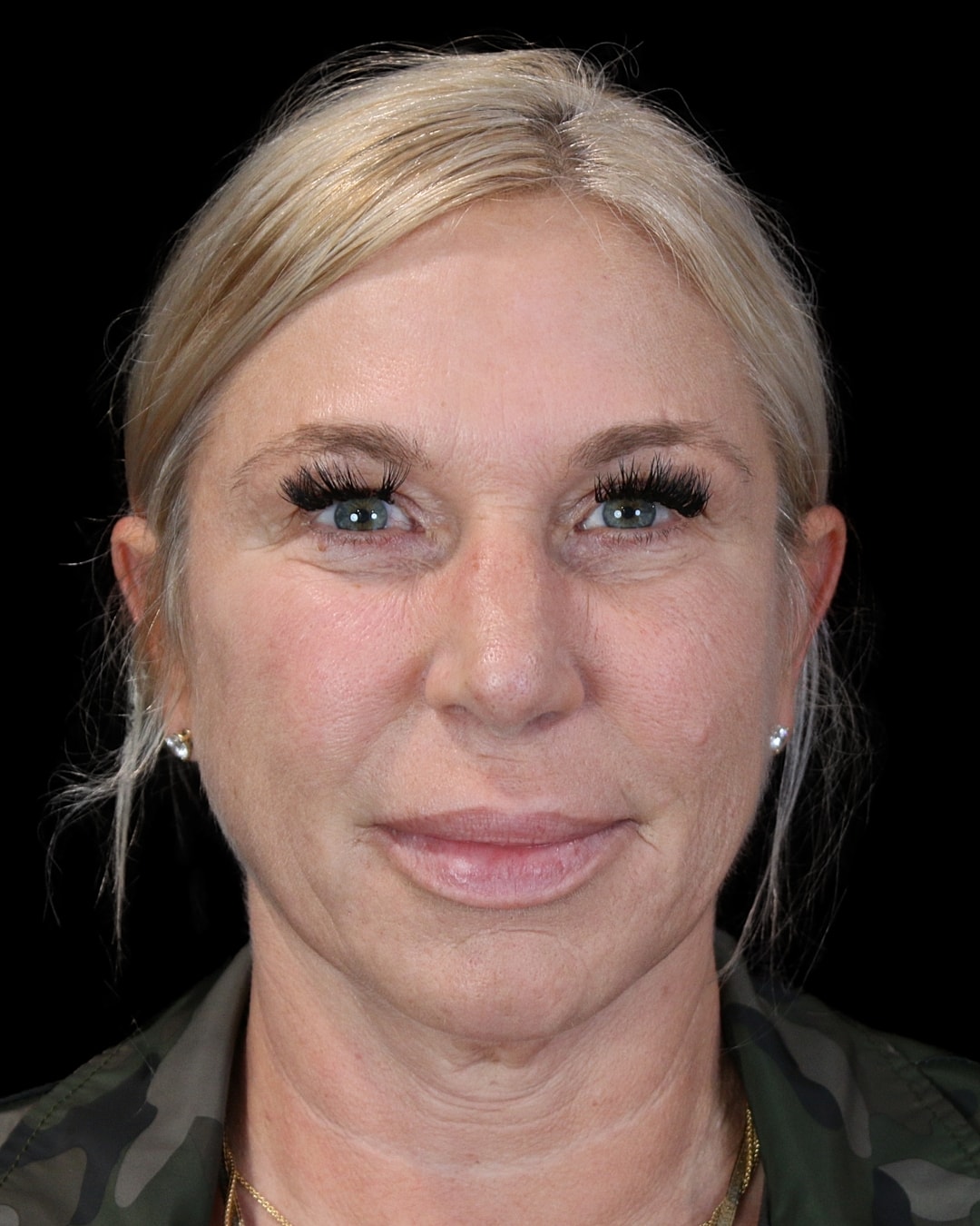Rhinoplasty Before & After