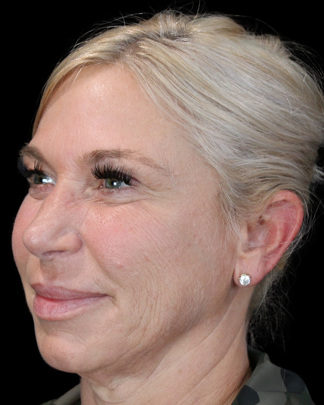 Rhinoplasty Before & After