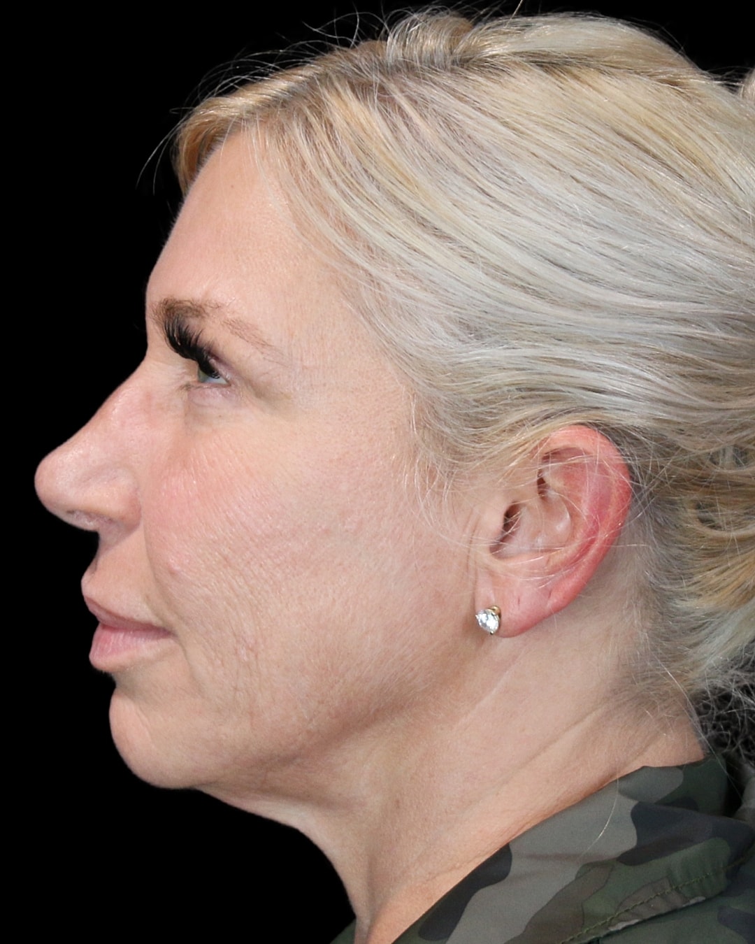 Rhinoplasty Before & After