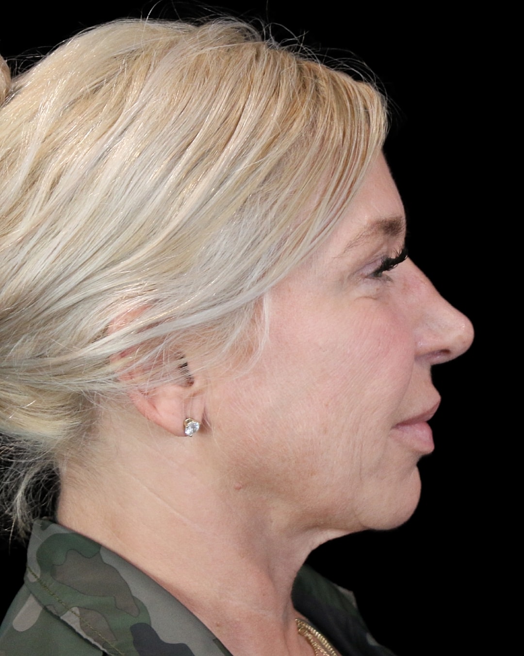Rhinoplasty Before & After
