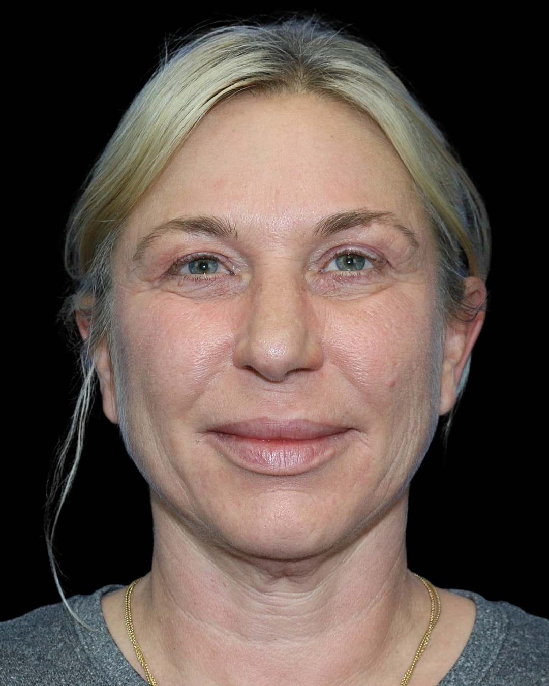Rhinoplasty Before & After