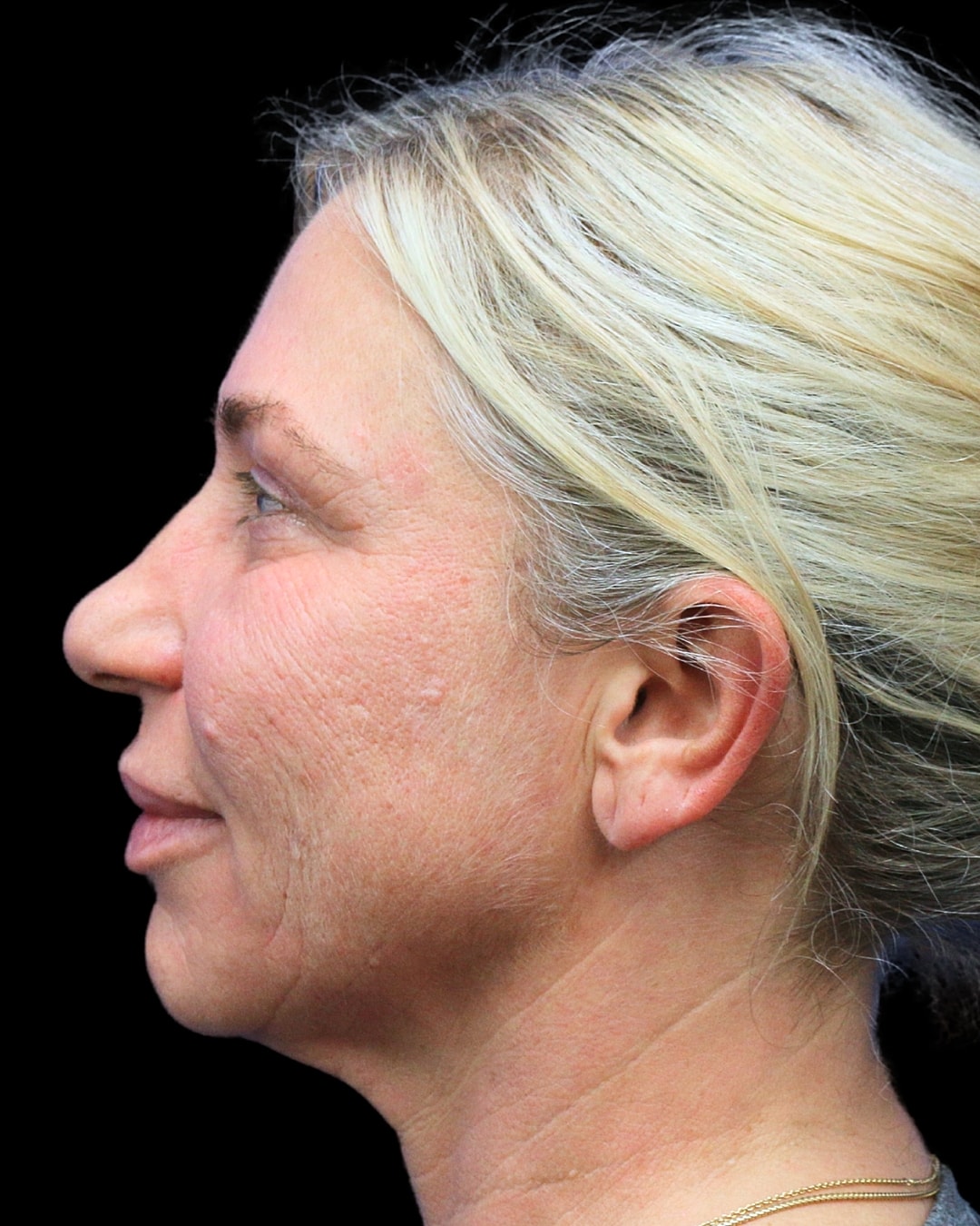 Rhinoplasty Before & After