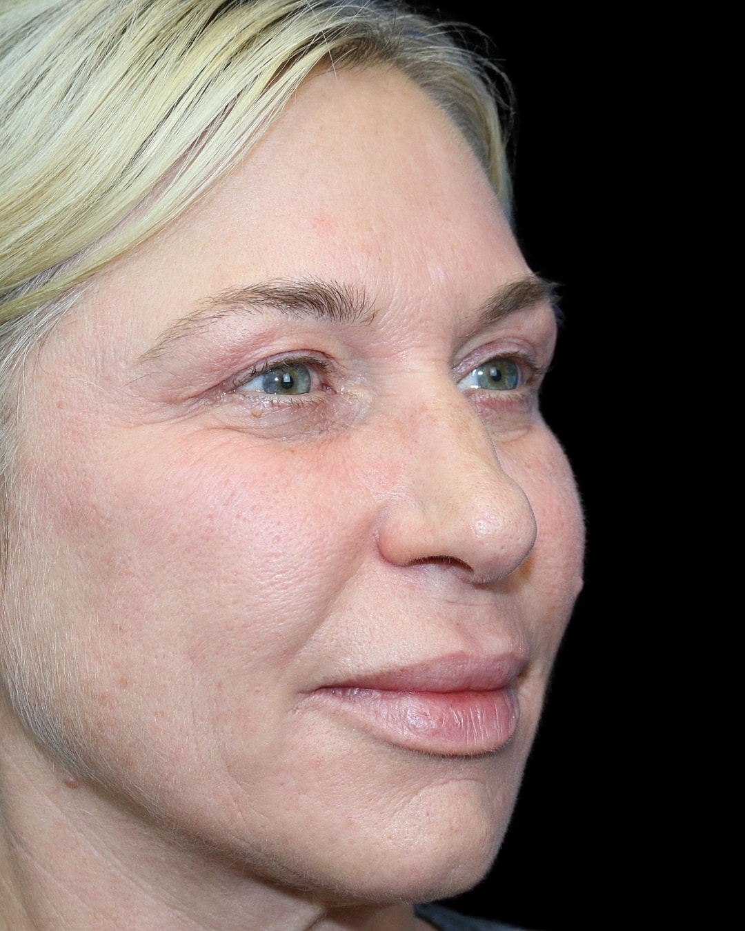 Rhinoplasty Before & After