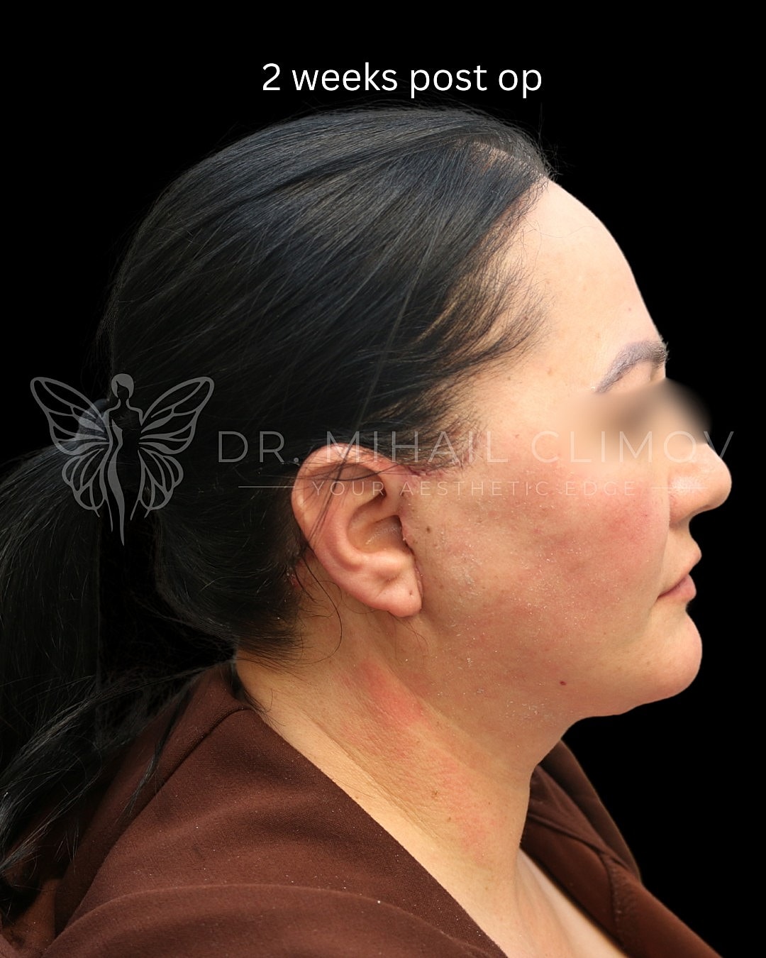 Profile view, two weeks post-surgery recovery.