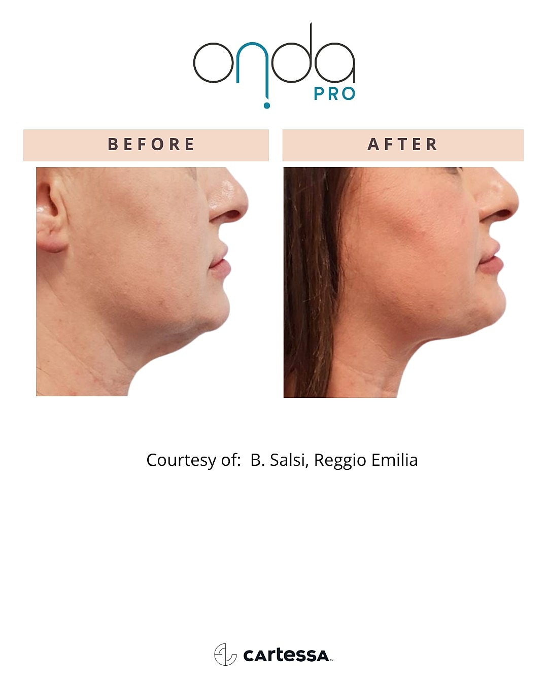 Onda Pro before and after treatment comparison.