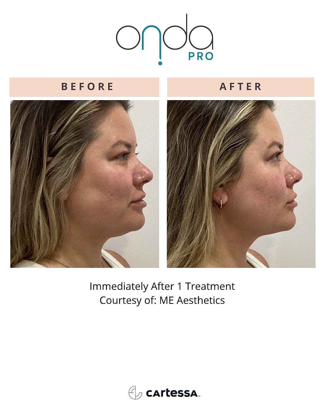 Onda Pro treatment results before and after.