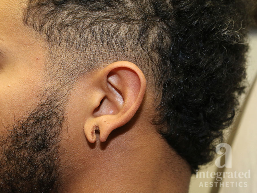 Earlobe repair before photo 2