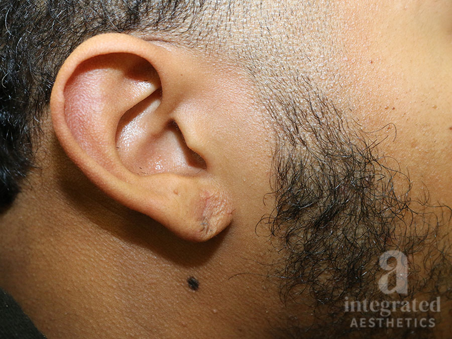 Earlobe repair after photo 1
