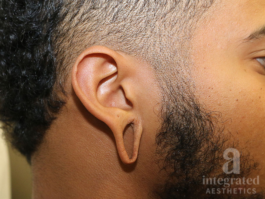 Earlobe repair before photo 1