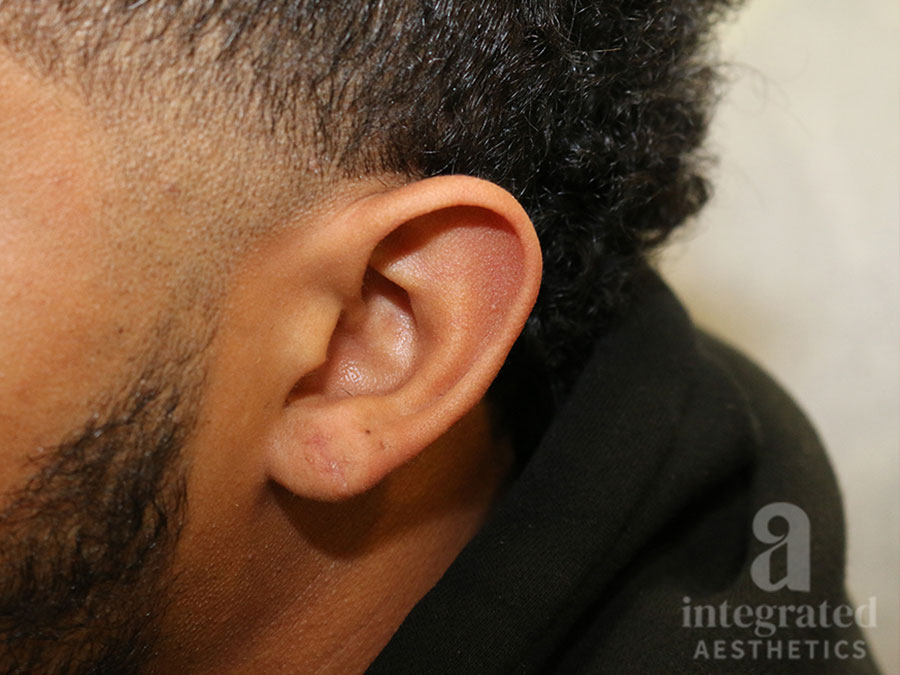 Earlobe repair after photo 2