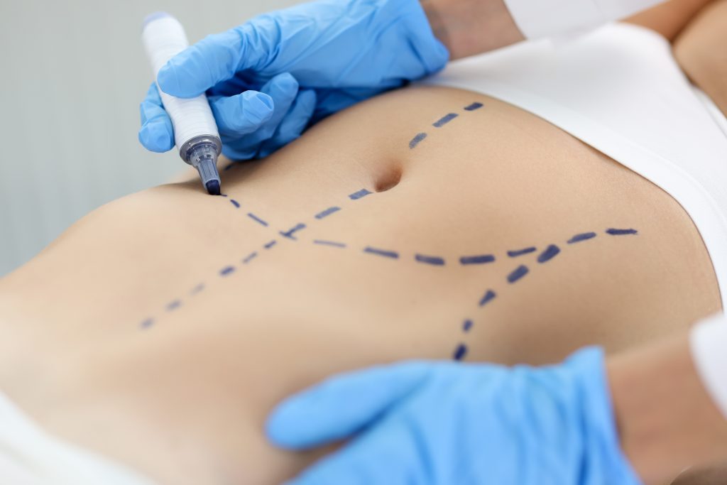 Surgeon marking a woman's abdomen before tummy tuck surgery, symbolizing preoperative planning and body contouring precision
