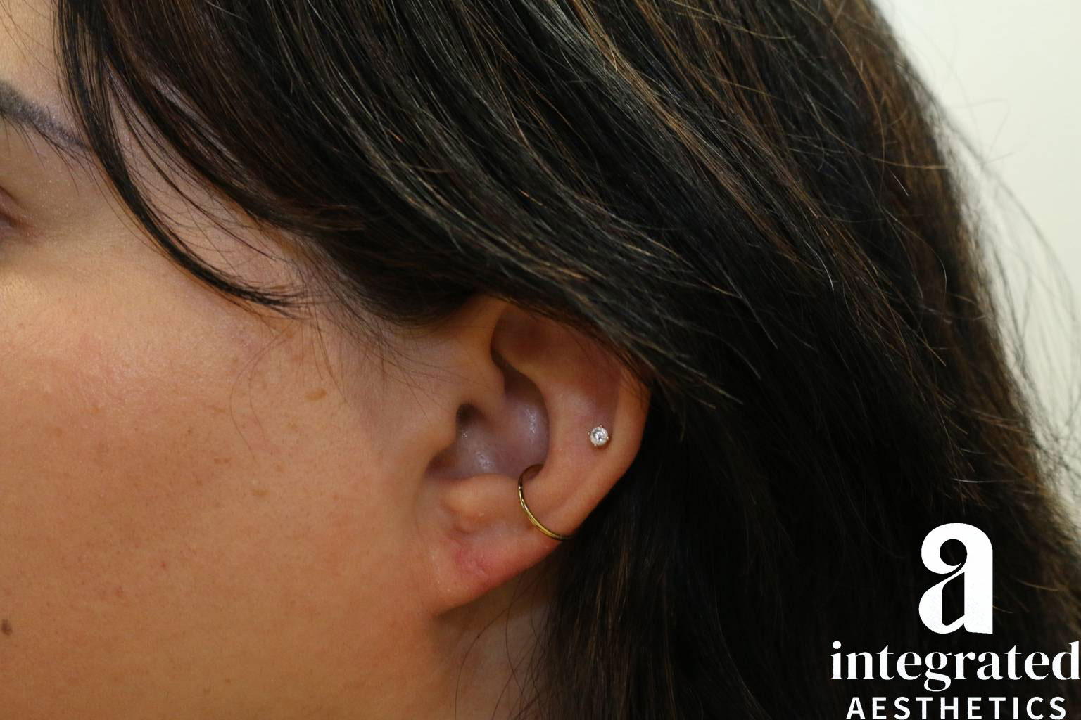 Earlobe repair after photo 1