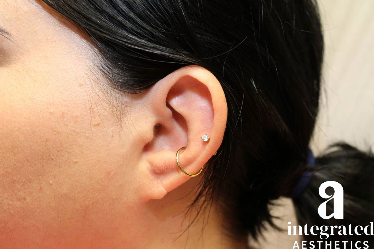 Earlobe repair before photo 1