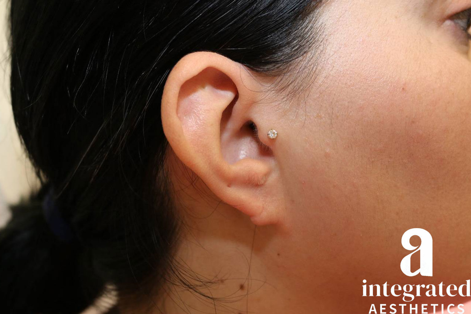 Earlobe repair before photo 2