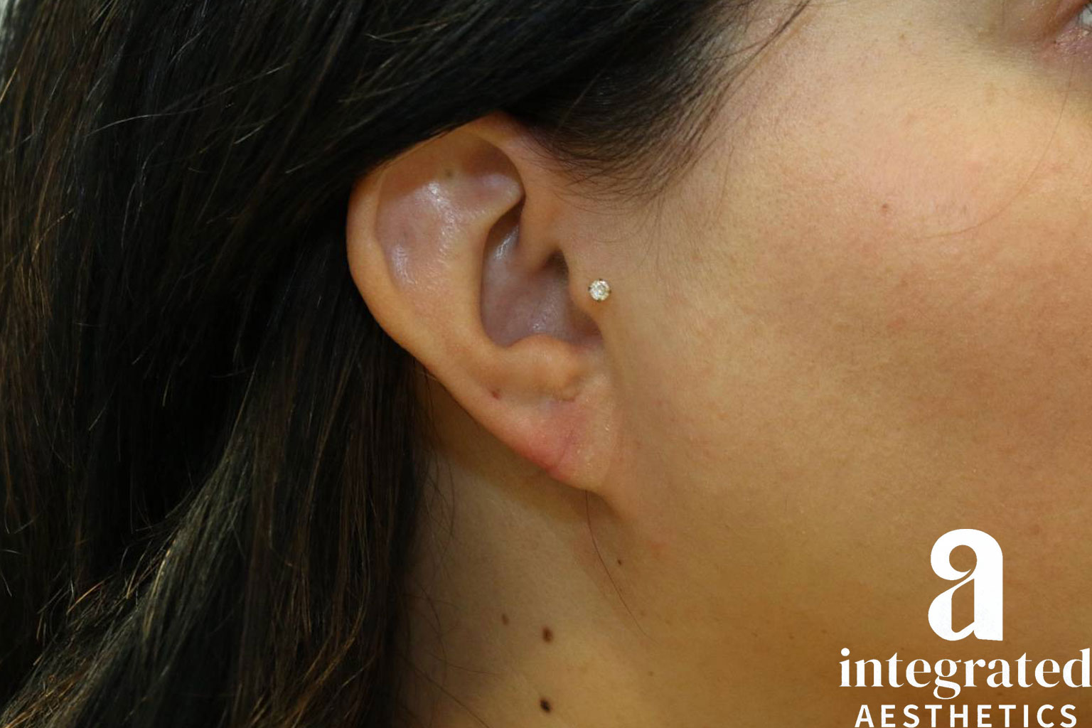 Earlobe repair after photo 2